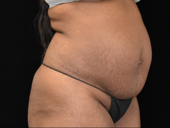 Abdominoplasty: Case 6 - Before
