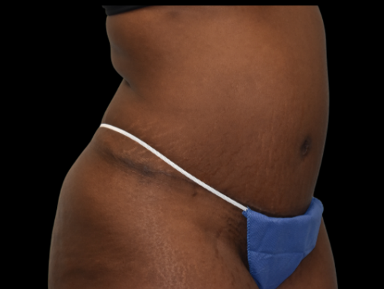 Abdominoplasty: Case 6 - After