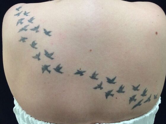 Laser Tattoo Removal Case 9 - Before