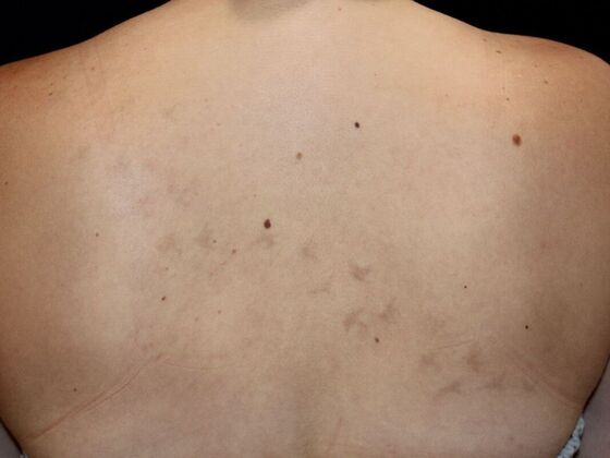 Laser Tattoo Removal Case 9 - After