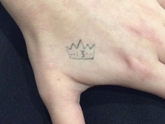 Laser Tattoo Removal Case 32 - Before