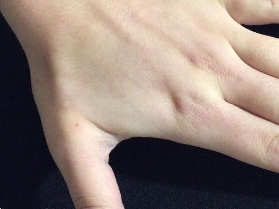 Laser Tattoo Removal Case 32 - After