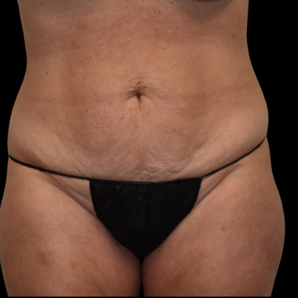 Abdominoplasty Case 7 - Before