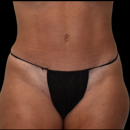 Abdominoplasty Case 7 - After