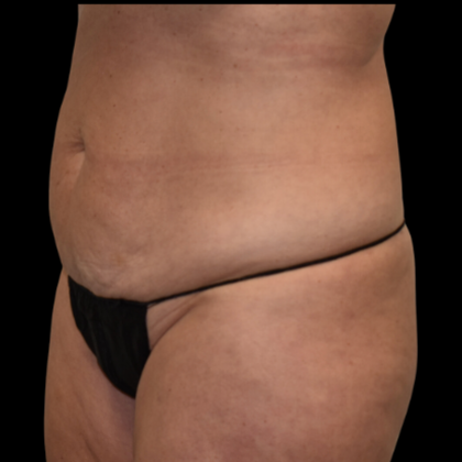 Abdominoplasty: Case 7 - Before