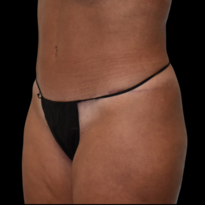 Abdominoplasty: Case 7 - After