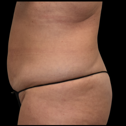 Abdominoplasty: Case 7 - Before