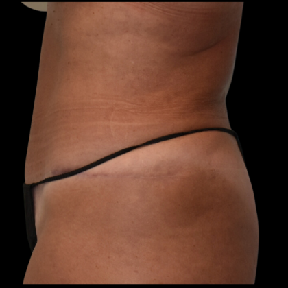 Abdominoplasty: Case 7 - After