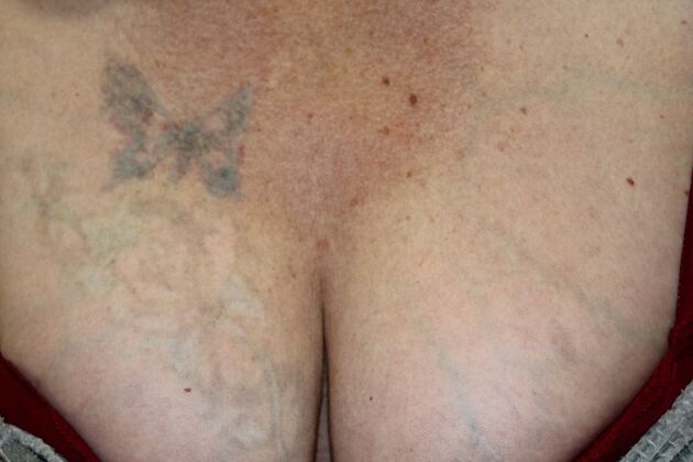 Laser Tattoo Removal Case 19 - After