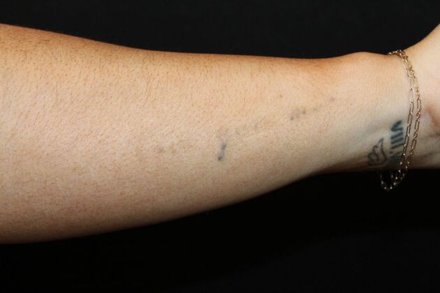 Laser Tattoo Removal Case 24 - After