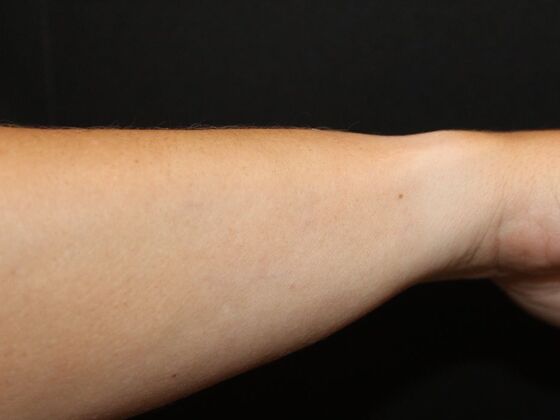 Laser Tattoo Removal Case 33 - After