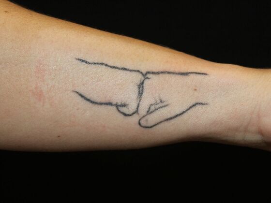 Laser Tattoo Removal Case 33 - Before