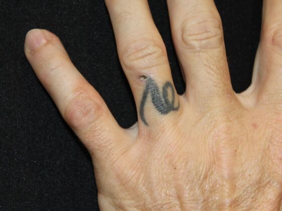 Laser Tattoo Removal Case 34 - Before