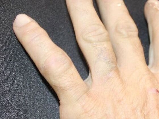 Laser Tattoo Removal Case 34 - After