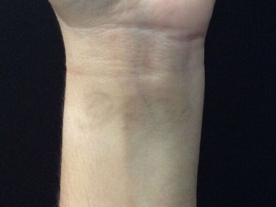 Laser Tattoo Removal Case 35 - After