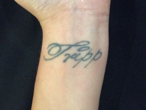 Laser Tattoo Removal Case 35 - Before