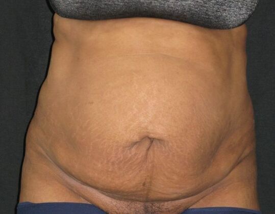Abdominoplasty: Case 9 - Before