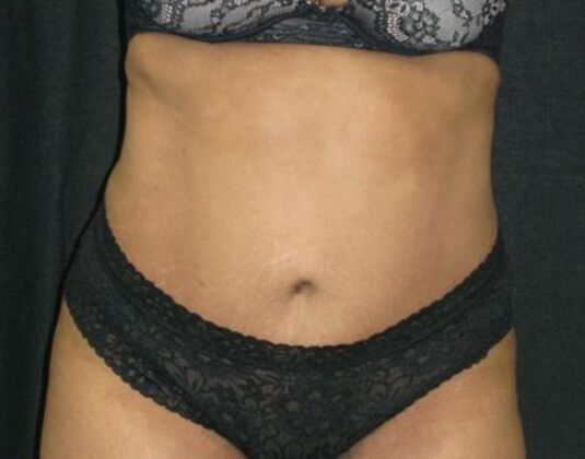 Abdominoplasty: Case 9 - After 2 years