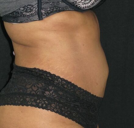 Abdominoplasty: Case 9 - After 2 years