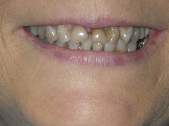 Cosmetic Changes with Veneers and Crown and Bridge: Case 6 - Before