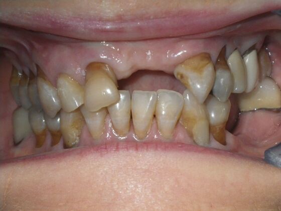Cosmetic Changes with Veneers and Crown and Bridge: Case 6 - Before