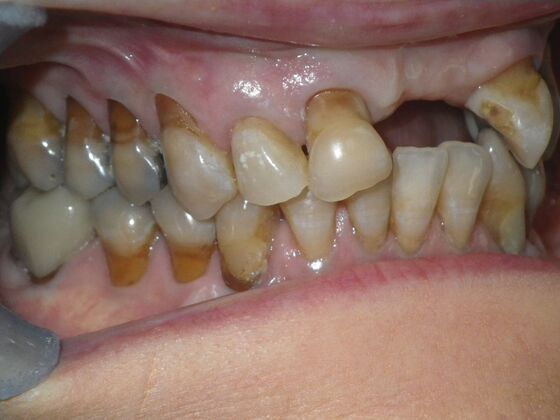 Cosmetic Changes with Veneers and Crown and Bridge: Case 6 - Before
