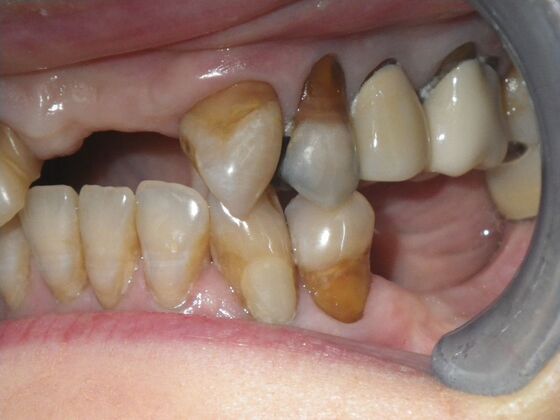 Cosmetic Changes with Veneers and Crown and Bridge: Case 6 - Before