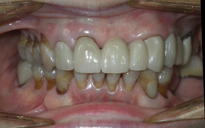 Cosmetic Changes with Veneers and Crown and Bridge: Case 6 - After