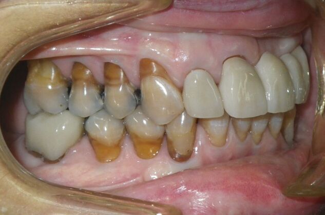 Cosmetic Changes with Veneers and Crown and Bridge: Case 6 - After
