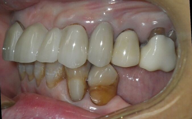 Cosmetic Changes with Veneers and Crown and Bridge: Case 6 - After