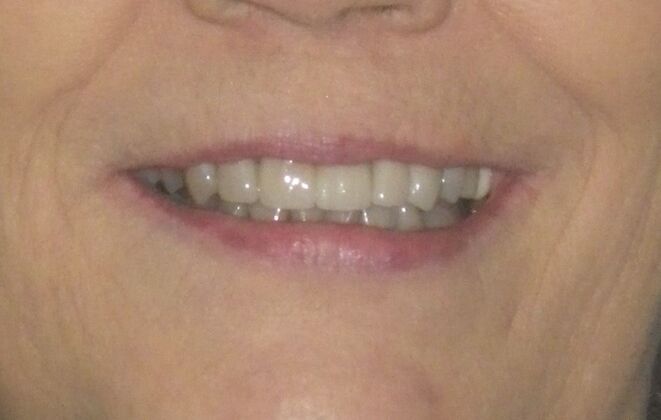Cosmetic Changes with Veneers and Crown and Bridge: Case 6 - After