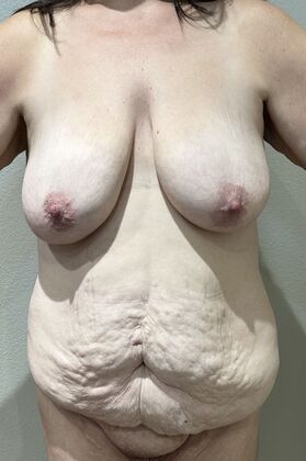 Massive Weight Loss : Case 134 - Before