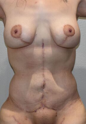 Mommy Makeover Case 276 - After