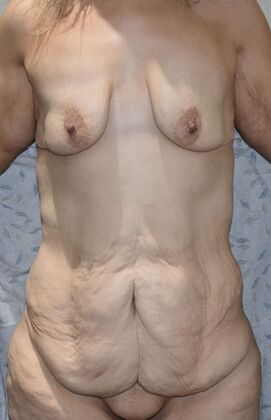 Mommy Makeover Case 276 - Before