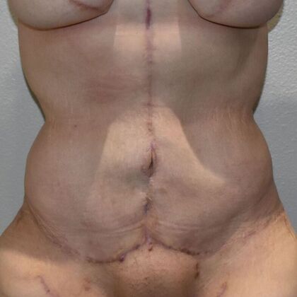 Tummy Tuck (Abdominoplasty): Case 429 - After