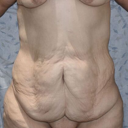 Tummy Tuck (Abdominoplasty): Case 429 - Before
