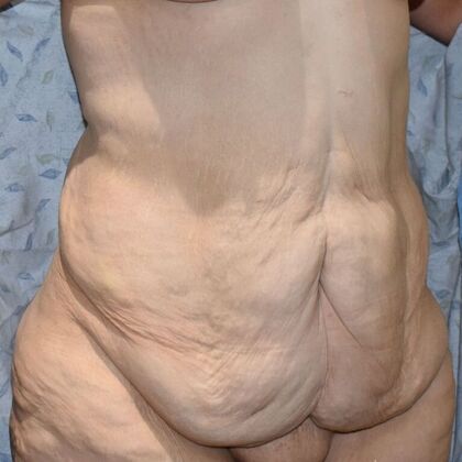 Tummy Tuck (Abdominoplasty): Case 429 - Before
