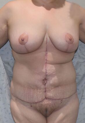 Massive Weight Loss : Case 136 - After