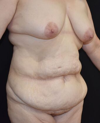 Massive Weight Loss : Case 136 - Before