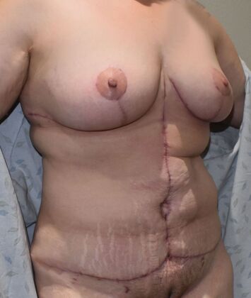 Mommy Makeover: Case 278 - After