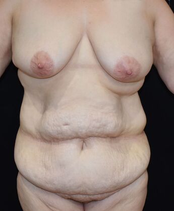 Mommy Makeover Case 278 - Before