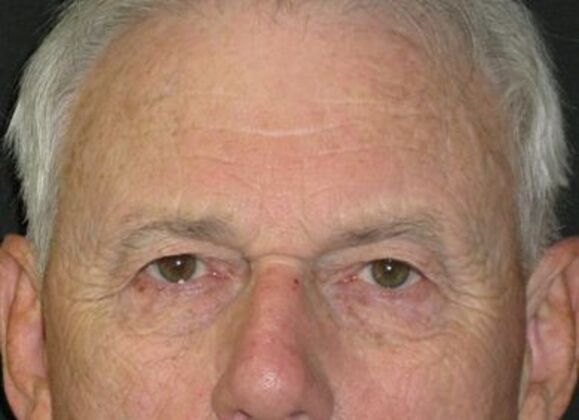blepharoplasty (eyelid lift) Case 6 - Before