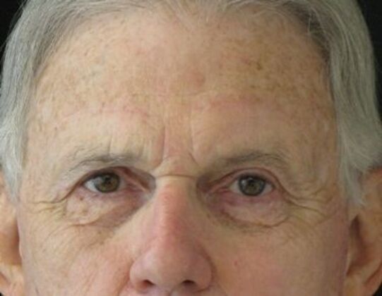 blepharoplasty (eyelid lift) Case 6 - After