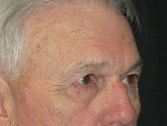 blepharoplasty (eyelid lift): Case 6 - Before