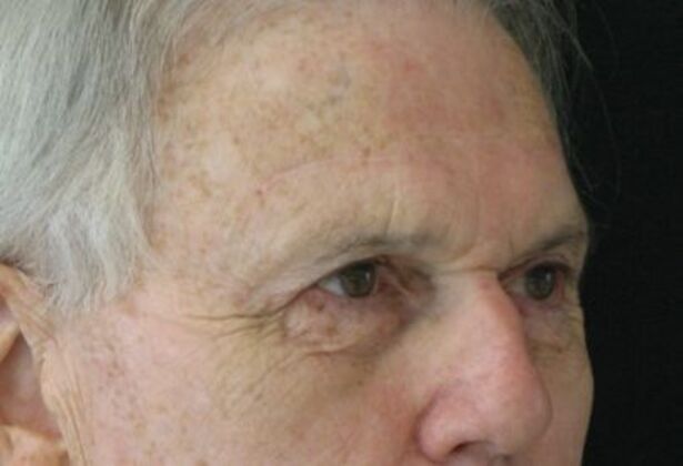 blepharoplasty (eyelid lift): Case 6 - After