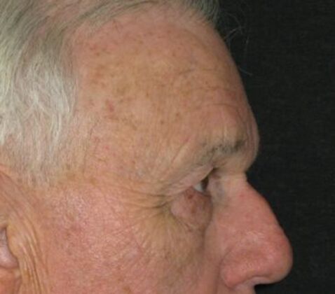 blepharoplasty (eyelid lift): Case 6 - Before