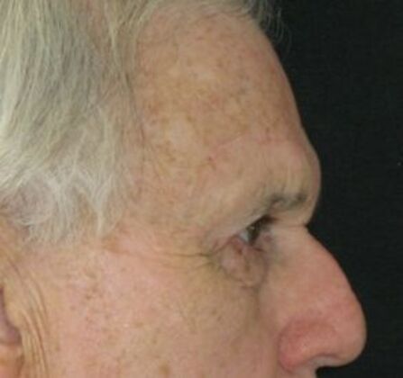 blepharoplasty (eyelid lift): Case 6 - After