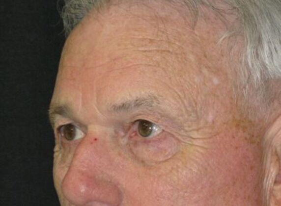 blepharoplasty (eyelid lift): Case 6 - Before