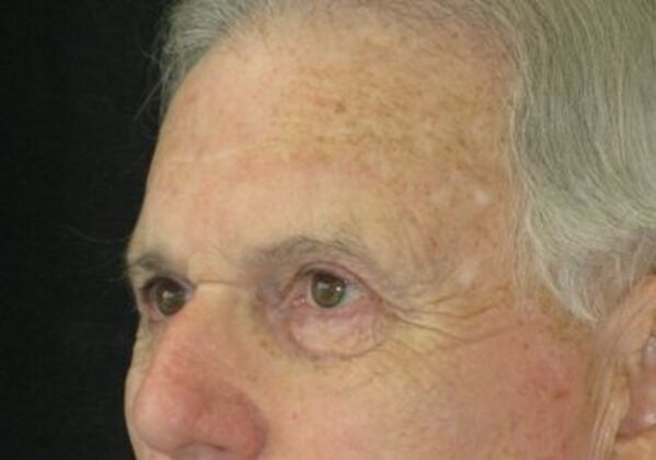 blepharoplasty (eyelid lift): Case 6 - After