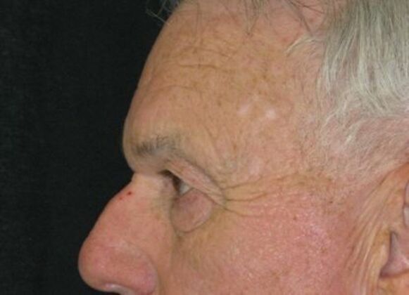 blepharoplasty (eyelid lift): Case 6 - Before